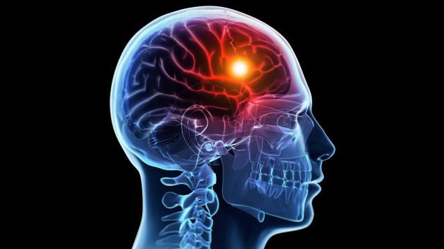 دواء موجود منذ 22 عاماً يعالج السكتات الدماغية لكن الأطباء يمنعونه عن المرضى!.. فما سره؟