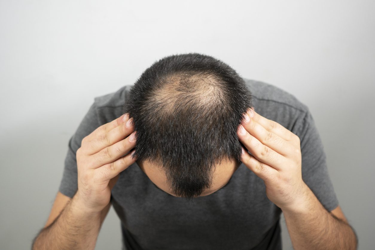 iStock/ زراعة الشعر