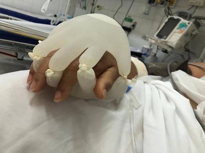 لإزالة شعور الوحدة عن مرضى كورونا المعزولين.. ممرضة برازيلية تبتكر “يداً زائفة” تمدهم بالدفء