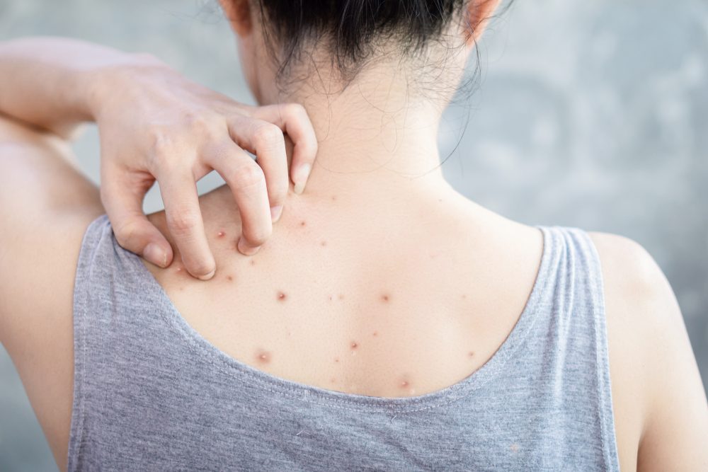 مزعجة ومؤلمة لكن اتباعك لبعض النصائح قد يخلّصك منها.. أسباب حبوب الظهر والكتفين وطرق علاجها