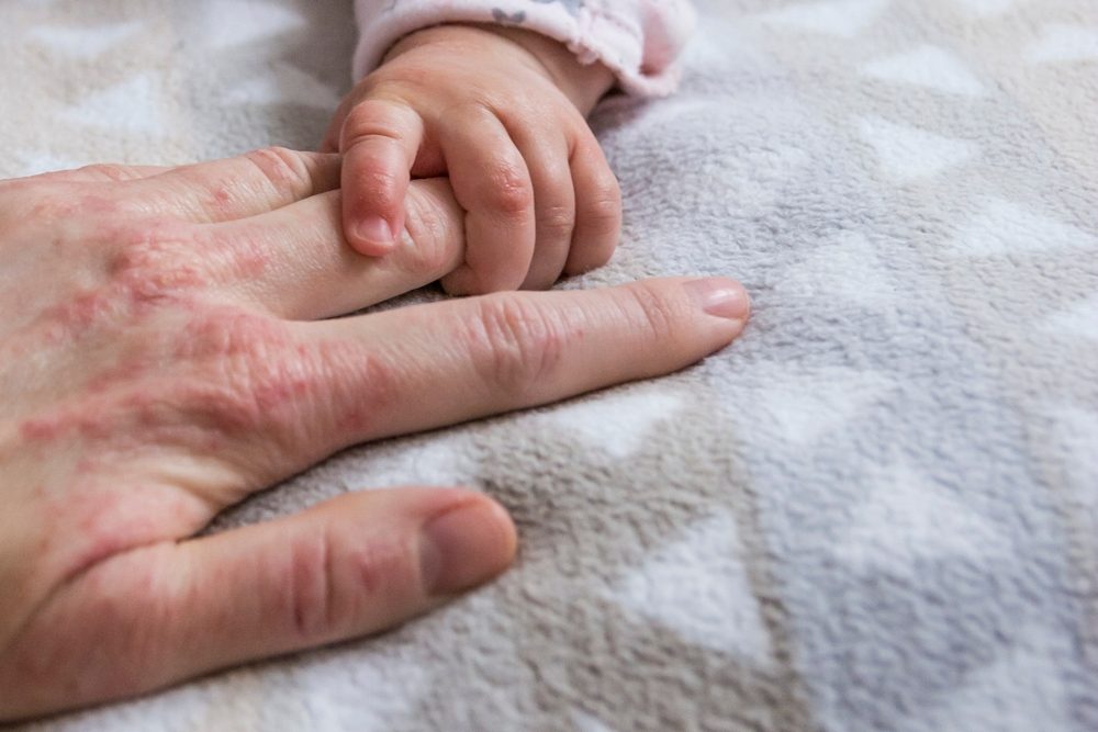 تختلف أكزيما البالغين عن التي تصيب الأطفال الصغار - shutterstock